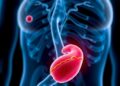 Stretchy Implants May Adhere to Arteries to Combat High Blood Pressure — Technology and Engineering