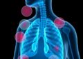 Study Reveals Multiple Health Conditions Common Among Severe Asthma Patients — Technology and Engineering