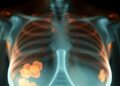 Triple-Negative Breast Cancer Ecotypes and Chemotherapy Response — Medicine