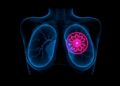 AI May Predict Breast Cancer Up to 6 Years Before Diagnosis — Technology and Engineering