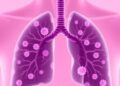 Anti-CD4 Therapy Boosts CD8+ Immunity, Halts Lung Cancer — Technology and Engineering
