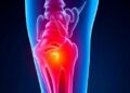 Evaluating Social Media on Femoral Head Necrosis — Technology and Engineering