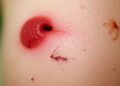 From Burn Scar to Cancer: A Case Highlights the Long-Term Danger of Marjolin Ulcers Decades Later — Biology