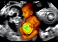 Innovative Noninvasive Method Shows Promise for Early Detection of Dangerous Intestinal Disease in Preterm Infants — Technology and Engineering