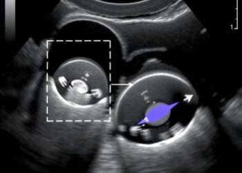 Ultrasound Elastography Advances Fetal Rabbit Lung Assessment — Technology and Engineering
