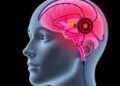 University of Michigan Achieves First-in-Human Implantation of Paradromics Wireless Brain-Computer Interface to Restore Communication — Medicine