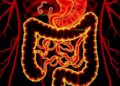Unraveling PET-MPs’ Role in Inflammatory Bowel Disease — Technology and Engineering