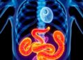 AI Model Predicts Necrotizing Enterocolitis Diagnosis and Surgical Outcomes