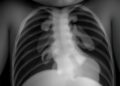 Alveolar Capillary Dysplasia in Neonates: Multicenter Study — Technology and Engineering