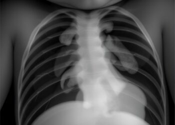 Alveolar Capillary Dysplasia in Neonates: Multicenter Study — Technology and Engineering