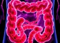 Breakthrough Marker Identified as the Achilles’ Heel of Highly Aggressive Metastatic Colorectal Cancer — Biology