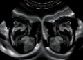 Delayed vs Early Cord Clamping in Preterm Twins: Echocardiography Study