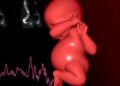 Echocardiography Hemodynamics in Preterm Infants Predict Neurodevelopment Through Age Three