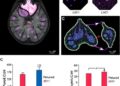LIG1 Loss Reveals Targetable Weakness Against Chemotherapy-Resistant Triple-Negative Breast Cancer
