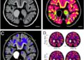 Metabolomic Profiling Reveals Subtype-Specific Molecular Programs in Pediatric Ependymoma