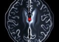 Millisecond magnetic particle imaging of a cerebral aneurysm phantom with and without flow diverter stent