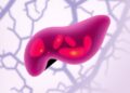 Steatosis Drives Liver Metastasis Diversity in CRC — Medicine