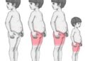 Atopic Dermatitis Phenotypes Linked to Long-Term Body Mass Index Trajectories