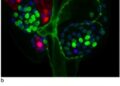 Cancer-associated fibroblast SERPINH1 drives epithelial-mesenchymal transition in clear cell kidney cancer