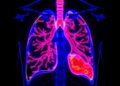 Dual-gain color-NIR chip enables fluorescence-guided lung and breast cancer surgery