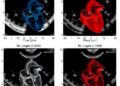 Early NT-proBNP Versus Echocardiographic PLASE Score for Predicting PDA Surgery