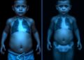 Electrical Impedance Tomography Shows Promise for Pediatric Clinical Care