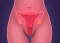 Endometriosis Linked to 46% Higher Type 2 Diabetes Risk in Women