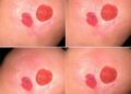 Explainable Skin Lesion Classification Uses Lightweight Multiscale Fusion, Convolutional Transformers, and SegmentAware-TreeSHAP