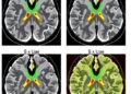 HisToSpatialCNV Predicts Spatial Copy-Number Variations from Pathology Images Using Interpretable Deep Learning