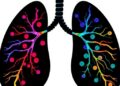 New CAF Population Directs Highly Suppressive Regulatory T Cells in Lung Tumors