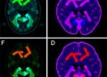 New neonatal hypoxic-ischemic model shows glial activation, memory deficits without neuronal loss