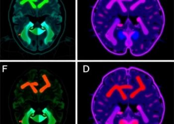 New neonatal hypoxic-ischemic model shows glial activation, memory deficits without neuronal loss
