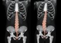 Posterior Transosseous S1 Pedicle Approach Reaches Superior Hypogastric Plexus