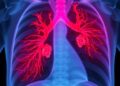 Pulmonary cryptococcosis emerges in diabetic, hypertensive patient without classic immunodeficiency