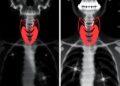 Randomized Trial Compares Lobectomy and Total Thyroidectomy for Indeterminate-Risk Thyroid Cancer