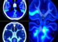 ShanghaiTech Researchers Develop Diffusion-Regularized Neural Representation to Reduce CT Metal Artifacts