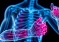 Study Reveals Shared Biological Mechanisms Linking Muscle Loss and Osteoporosis