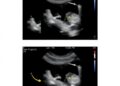 Ultrasound-Guided Nasojejunal Tube Placement Reduces Malposition and Radiation in Newborns
