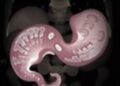 Unresectable Gallbladder Cancer Develops Rare Spontaneous Cholecystocutaneous Fistula, Case Report Finds