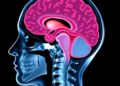 Young Survivors Face Lifelong Risk of New Aneurysms After Subarachnoid Hemorrhage