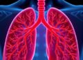 Younger lung cancer patients more likely to harbor targetable mutations, study finds