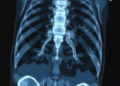 AI Learns to Read Fuzzy Bone Scans and Write Radiology Reports