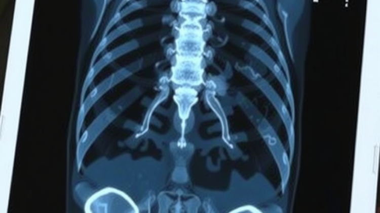 AI Learns to Read Fuzzy Bone Scans and Write Radiology Reports