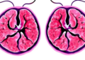 AI Reads Three Layers of Breast Cancer Biology at Once to Sharpen Subtype Diagnosis
