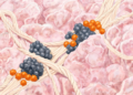 AI maps collagen highways and myeloid roadblocks that trap T cells in pancreatic cancer