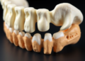 Calcium Phosphate Ceramic Bridges Mechanical Repair and True Bone Regeneration