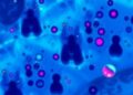 Degranulated eosinophilia offers unexpected diagnostic clue for ectopic paragonimiasis