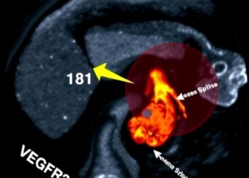 GV21 ultrasound imaging tracks VEGFR2 for early tumor therapy assessment