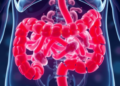 Gut Microbe Link Revealed in Down Syndrome Obesity Risk