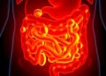 Gut fungi shift between flares and remission in ulcerative colitis patients